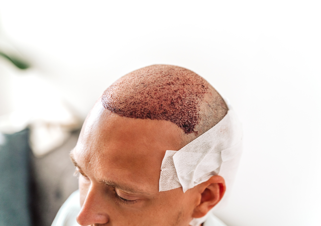 Glatzköpfiger Mann trägt Verband und wird auf Haartransplantation vorbereitet