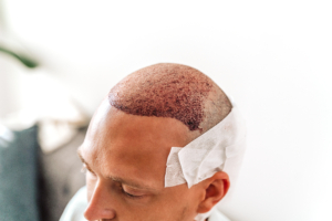 Glatzköpfiger Mann trägt Verband und wird auf Haartransplantation vorbereitet