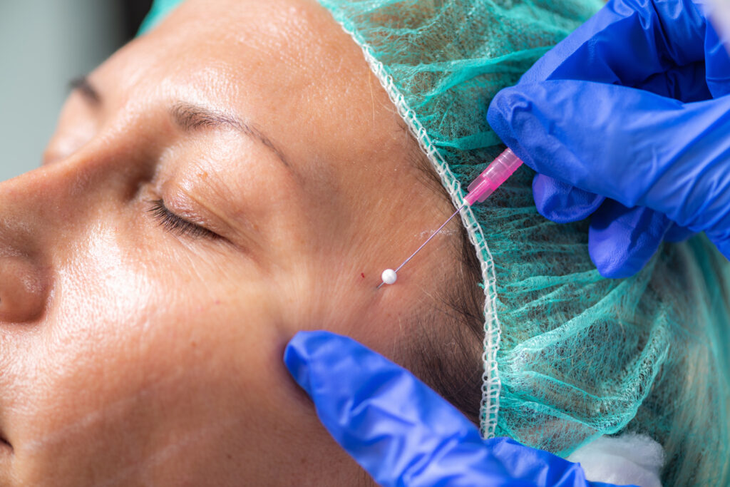 Frau in Operationsgewand wird an der Schläfe mit Fäden und Nadel behandelt