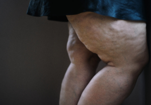 Dicke Oberschenkel mit Lipödemen und Cellulite