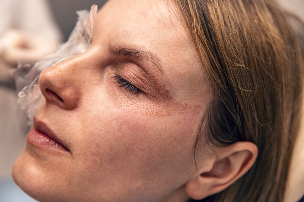 Gesicht einer Frau nach bzw. während einer Fibroblasten-Behandlung