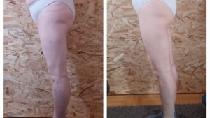 Sanfte Lymphdrainage im Umadum Gsund – Studio by Selina in St. Martin verbessert sichtbar das Hautbild – mit innovativer Technologie zu einer glatteren, strafferen und jugendlicheren Haut