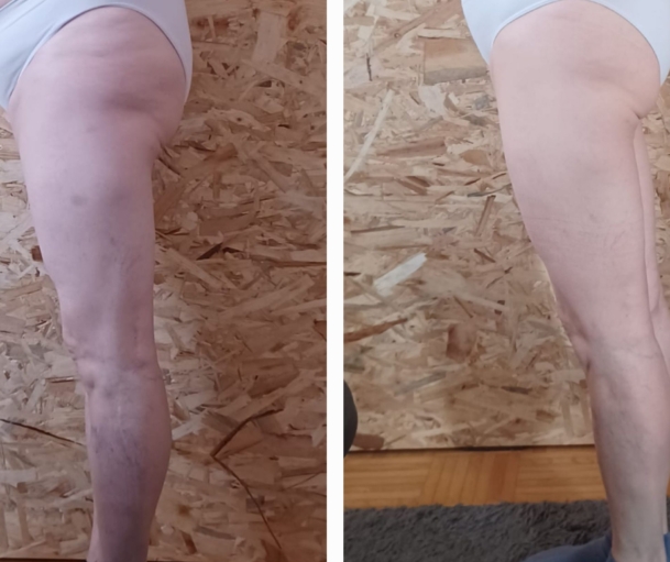 Sanfte Lymphdrainage im Umadum Gsund – Studio by Selina in St. Martin verbessert sichtbar das Hautbild – mit innovativer Technologie zu einer glatteren, strafferen und jugendlicheren Haut