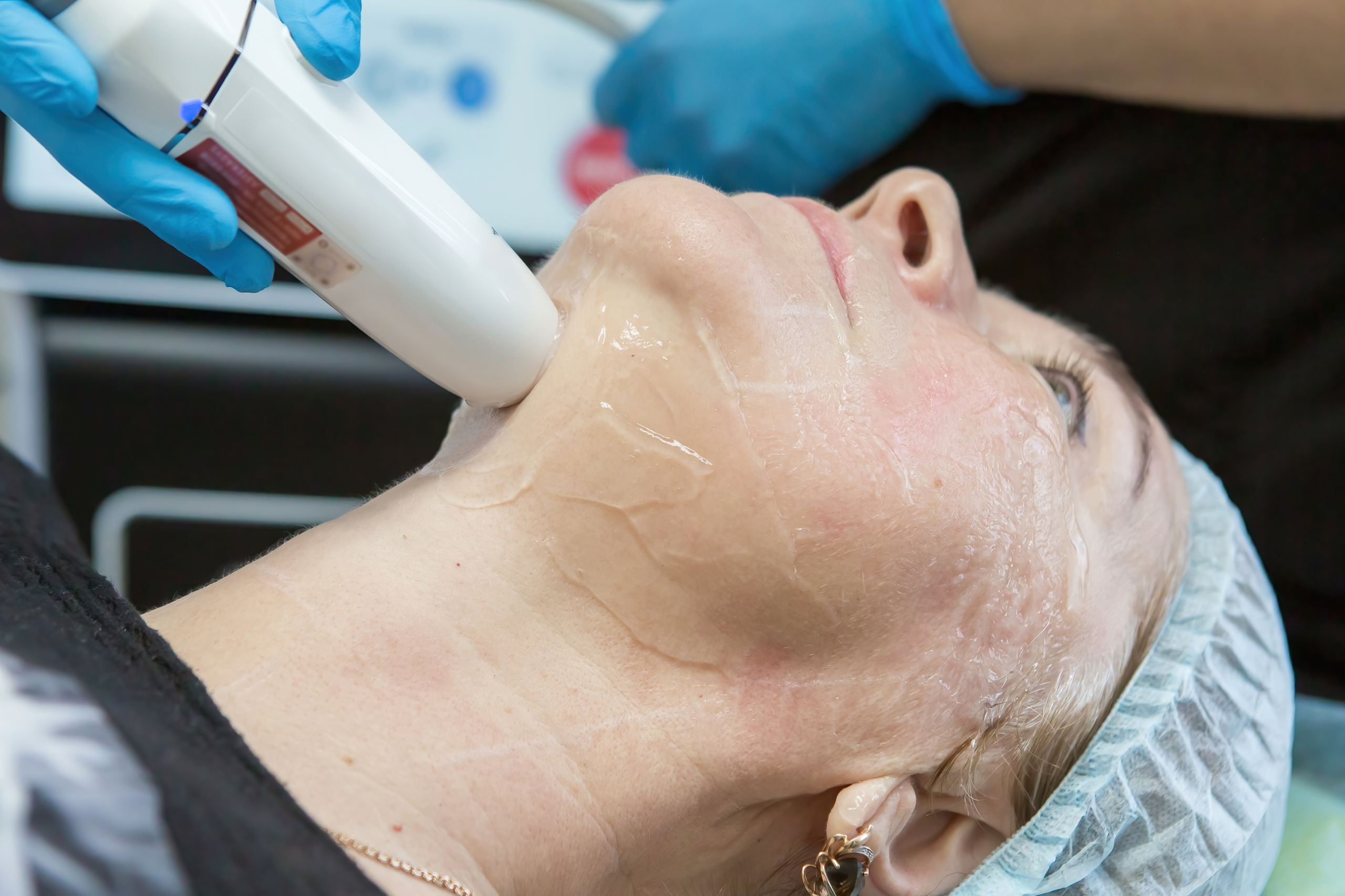 h2 jet peeling wird bei Frau angewandt