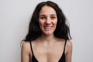 Ein großes Porträt einer jungen Frau mit Hautproblemen - Pickel, Akne, vergrößerte Poren.