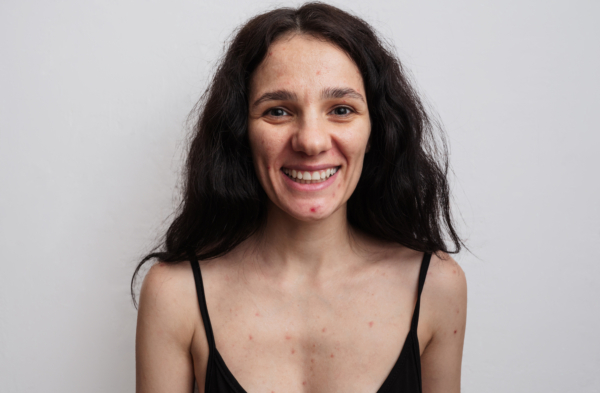 Ein großes Porträt einer jungen Frau mit Hautproblemen - Pickel, Akne, vergrößerte Poren.