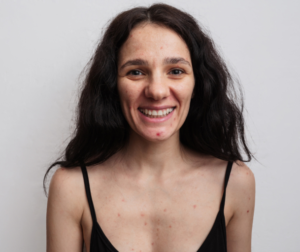 Ein großes Porträt einer jungen Frau mit Hautproblemen - Pickel, Akne, vergrößerte Poren.