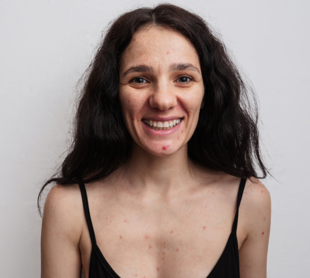 Ein großes Porträt einer jungen Frau mit Hautproblemen - Pickel, Akne, vergrößerte Poren.