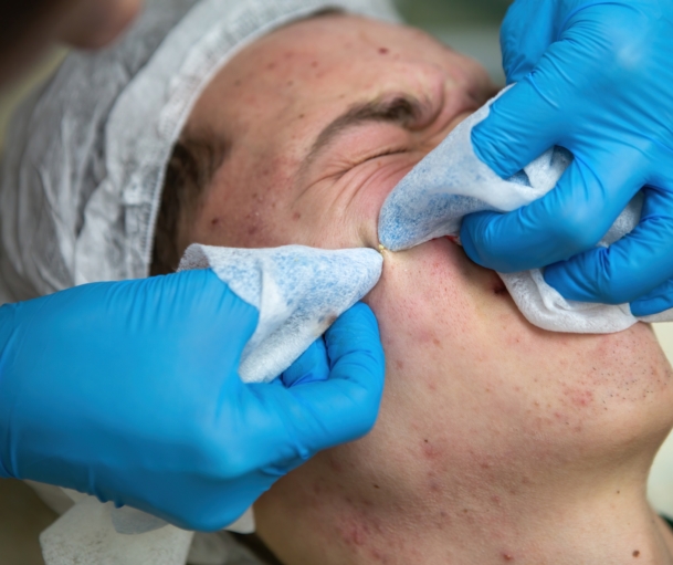Pickel werden bei Frau ausgedrückt